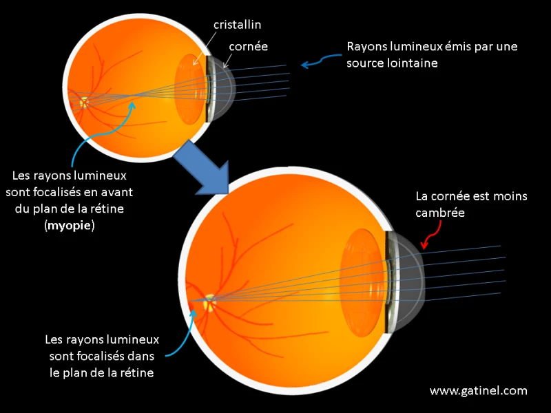 le-laser-une-technologie-sure-et-precise